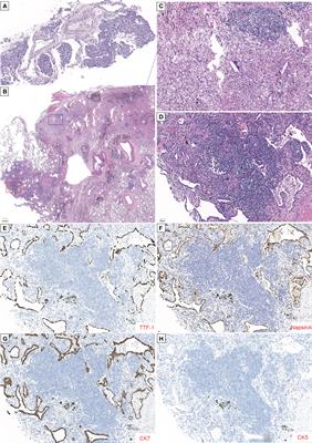 Dramatic response to neoadjuvant savolitinib in marginally resectable lung adenocarcinoma with MET exon 14 skipping mutation: A case report and literature review